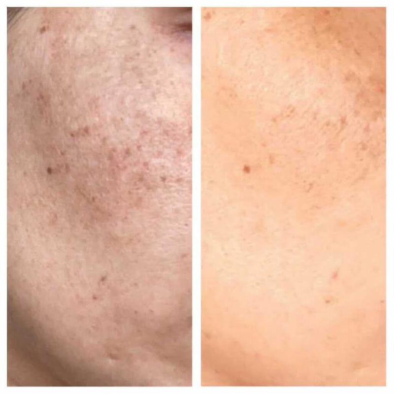 Close-up before and after photo showing reduction in facial pigmentation and dark spots