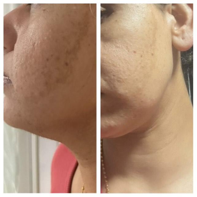 Before and after pigmentation treatment on jawline and cheek with CWG