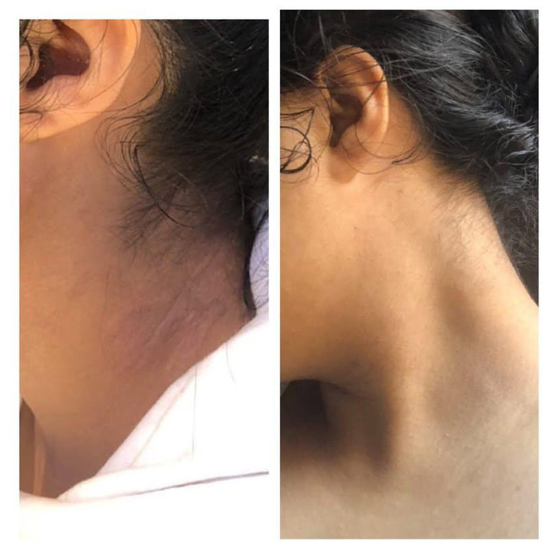 Before and after skin brightening on neck and behind the ear area