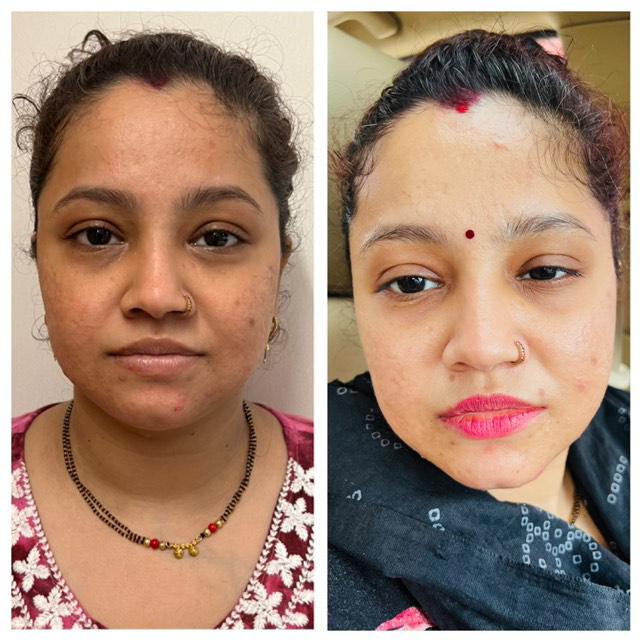 Front view before and after facial skin clarity and acne improvement
