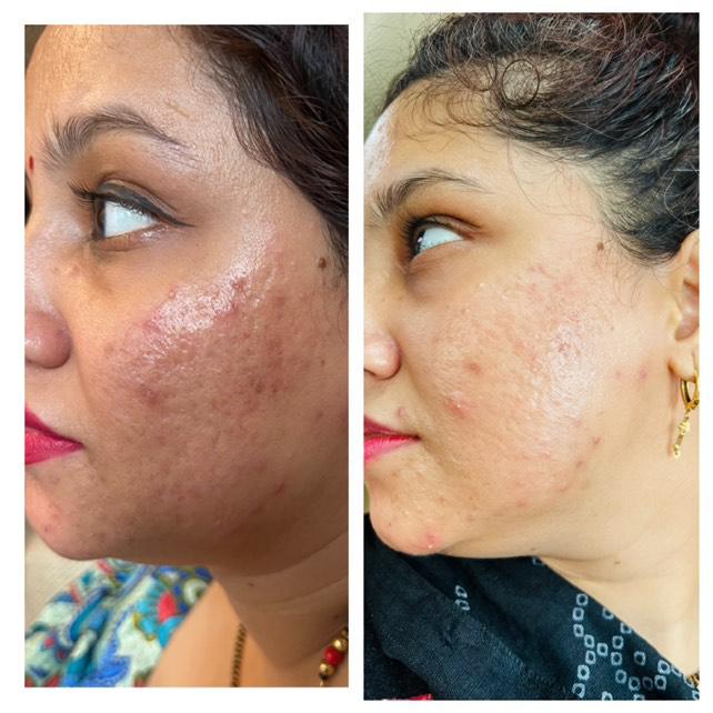 Before and after photo showing reduction in acne and scarring on cheek