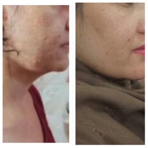 Before and after photo showing improvement in facial scarring and skin texture