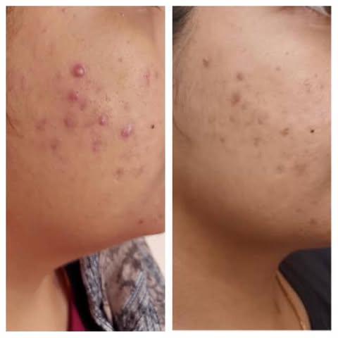 Before and after photo showing reduction in active cheek acne and inflammation
