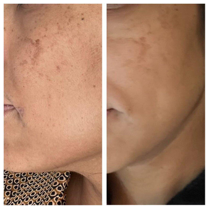Before and after photo showing fading of facial pigmentation and dark spots