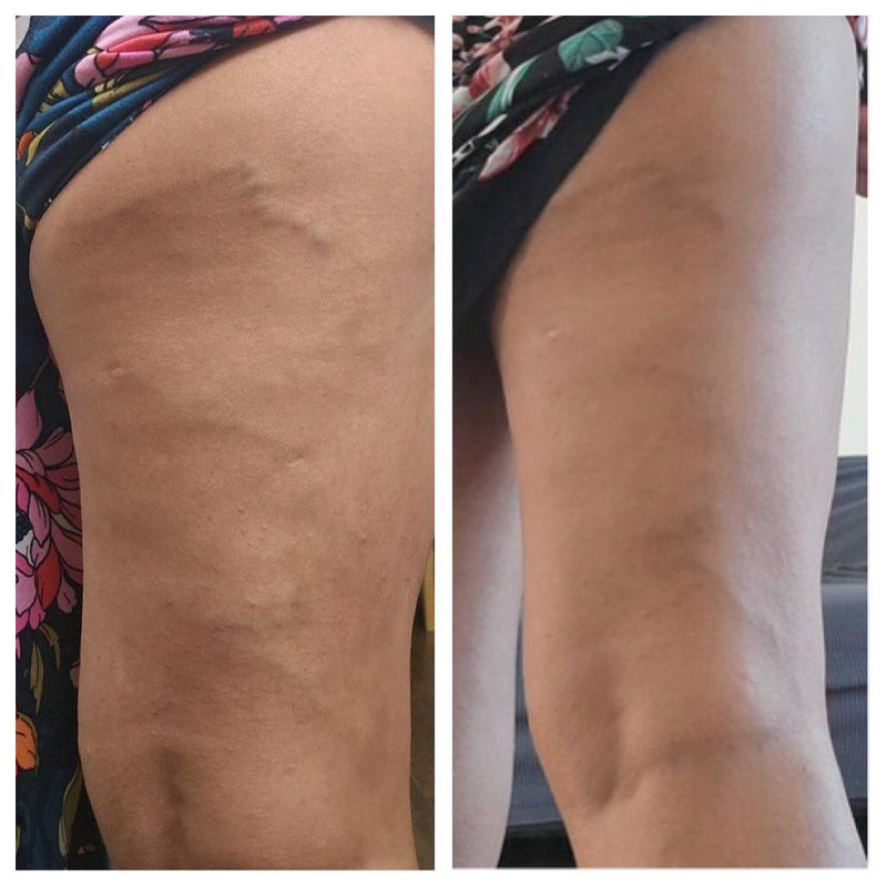 Before and after photo showing improvement in skin texture and marks on the thigh