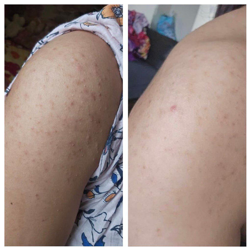 Before and after photo showing improvement in rough, bumpy skin texture on the arm