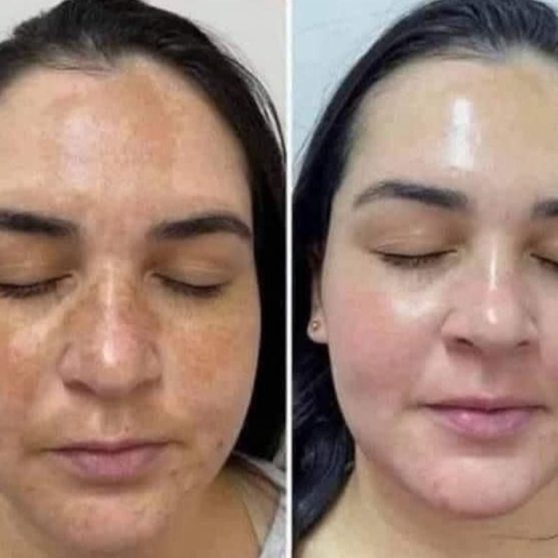 Before and after pigmentation and melasma reduction on face after CWG