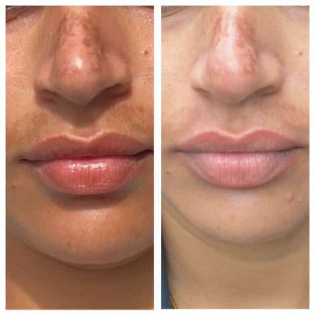 Before and after upper lip and nose pigmentation fading – GC nutrition counselling result