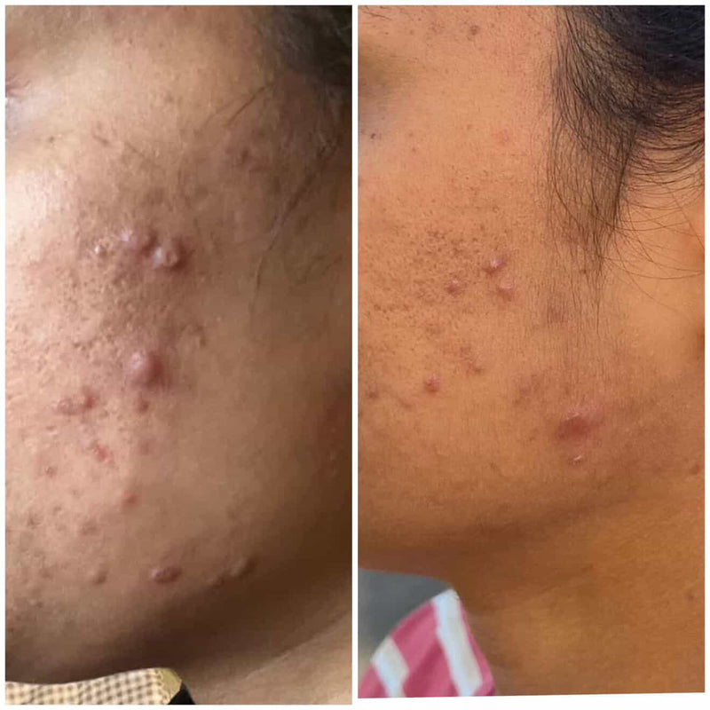 Before and after cystic acne improvement on jawline after CWG