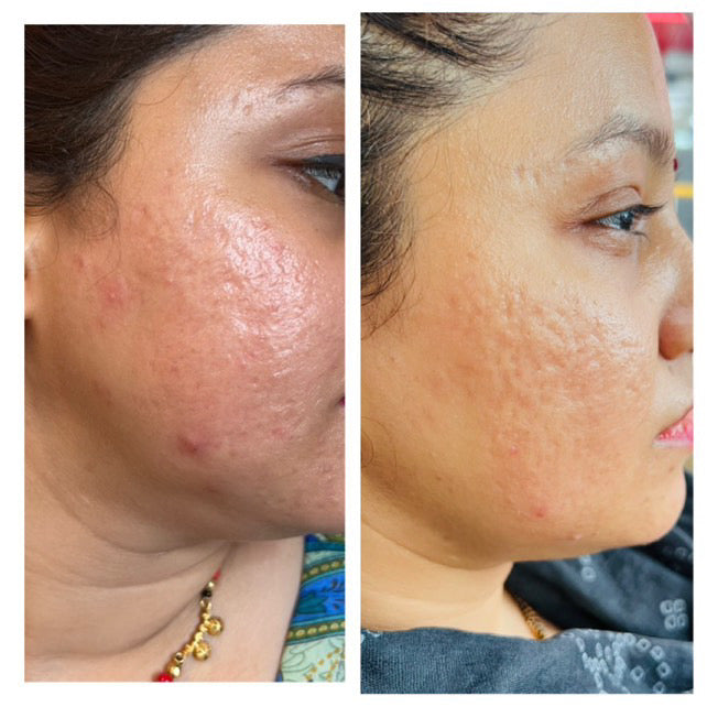 Before and after acne scarring improvement on cheek after CWG