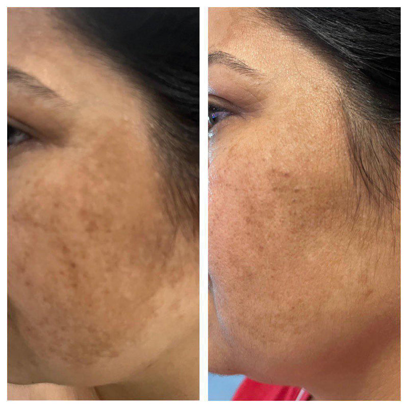 Before and after pigmentation fading on face – nutrition-led skintransformation by GC Diet