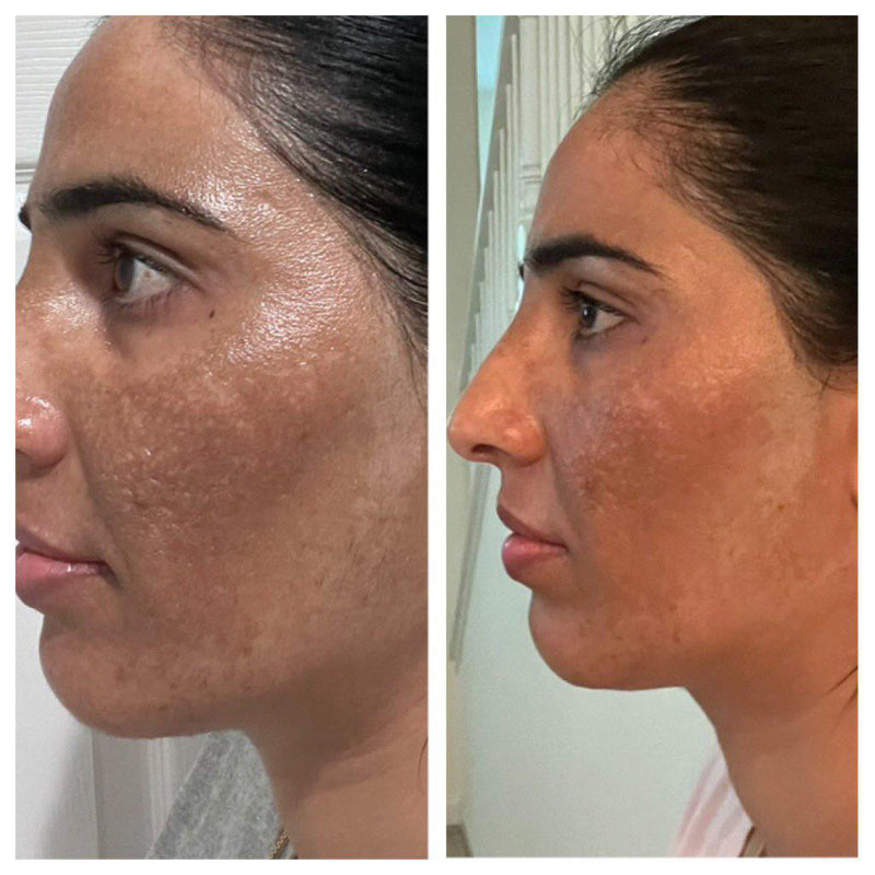 Before and after melasma and dark patches improvement on face –Gurleen Chopra nutrition counselling result