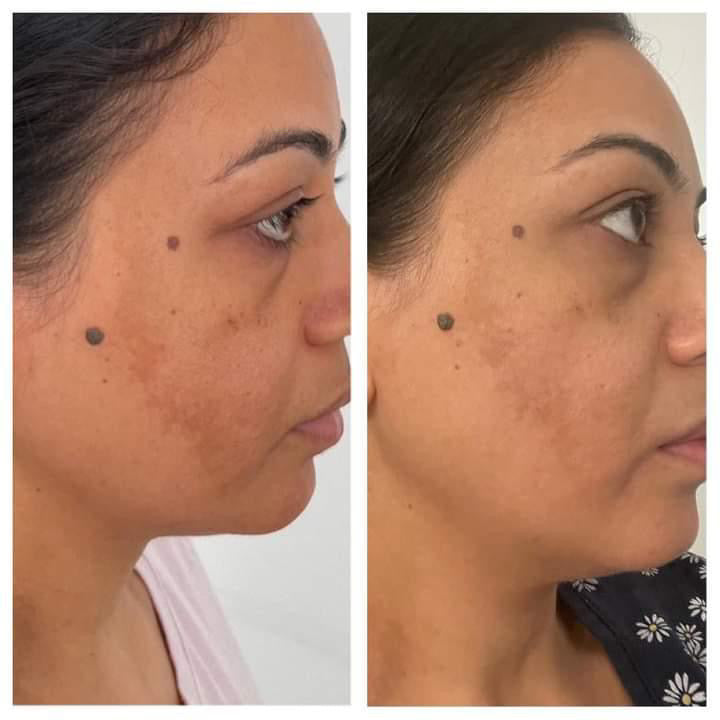 Before and after pigmentation reduction on cheek – nutrition-ledskin transformation by Gurleen Chopra