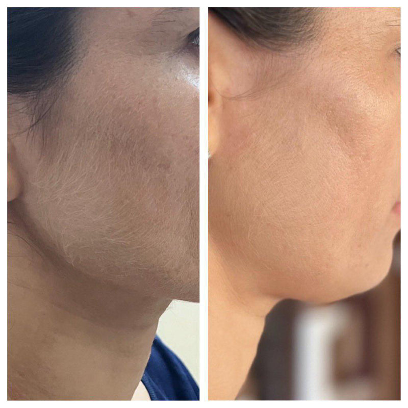 Before and after skin tone and clarity improvement on cheek – GC wellness transformation