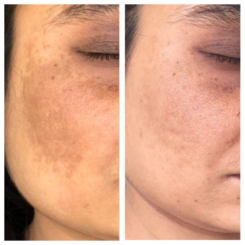 Before and after pigmentation and dark patch reduction on cheek – Gurleen Chopra nutrition and wellness client