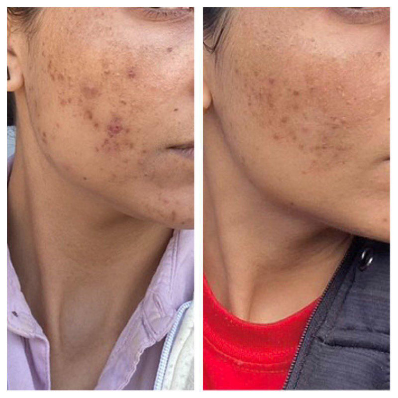 Before and after acne healing and scar fading on cheek – GC skin wellness transformation