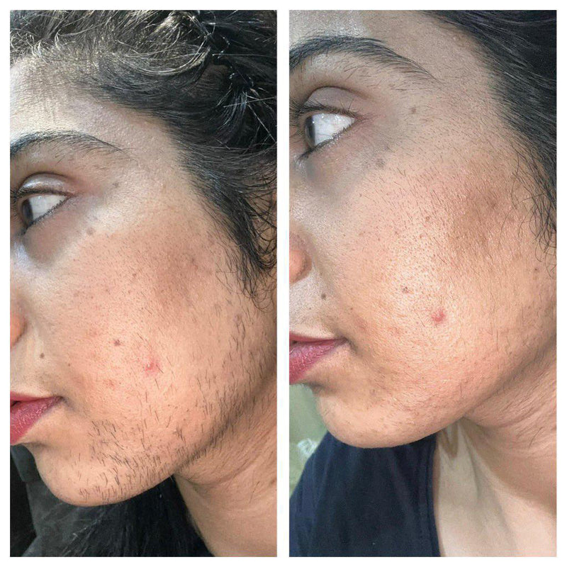Before and after dark spots and acne marks fading on cheek and  remove face hair – GC wellness transformation