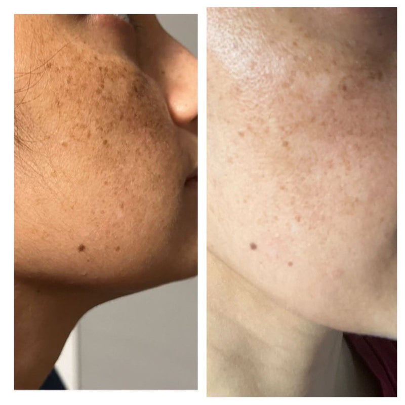 Before and after acne and oily skin improvement through GurleenChopra's diet and wellness counselling