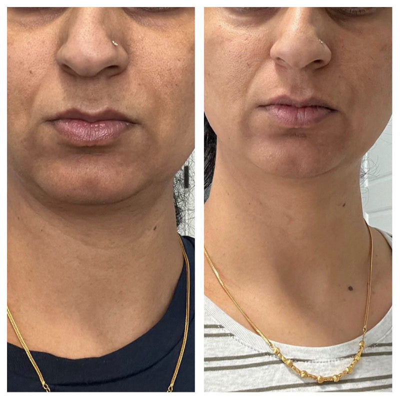 Before and after jawline and skin clarity transformation with nutrition and wellness program
