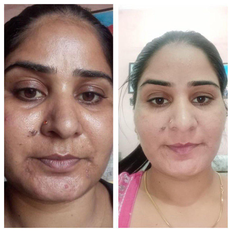 Before and after pigmentation and dark spot reduction on cheek –nutrition-led skin transformation