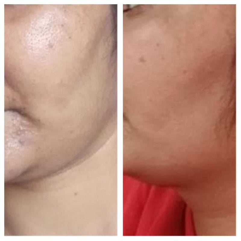 Before and after clear skin transformation on cheek and jaw –Gurleen Chopra nutrition counselling client result