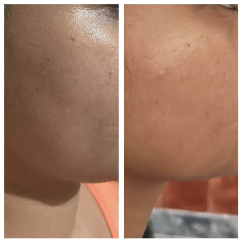 Before and after skin tone improvement from Gurleen Chopra nutritioncounselling – dull pigmented skin transformed to brighter evencomplexion