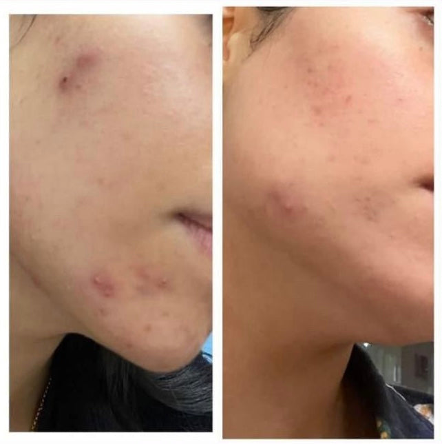 Before and after acne healing and clearer skin on cheek – GC Diet client transformation