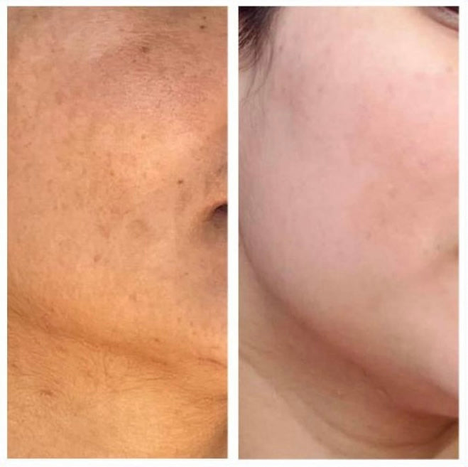Before and after skin pigmentation and tone improvement on cheek – GC Diet result