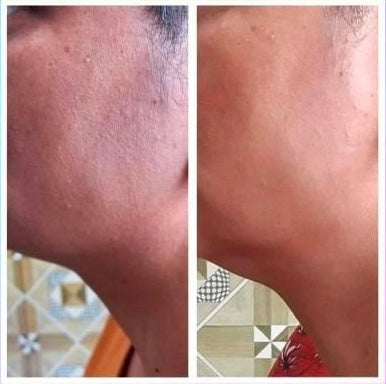 Before and after jawline skin clarity improvement – GC Diet client result