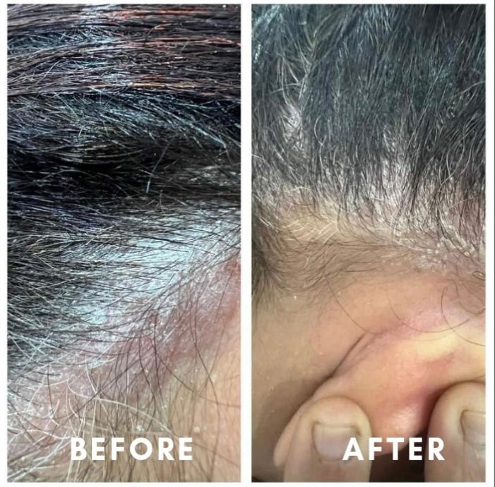 Before and after scalp health and dandruff improvement – GC Diet client