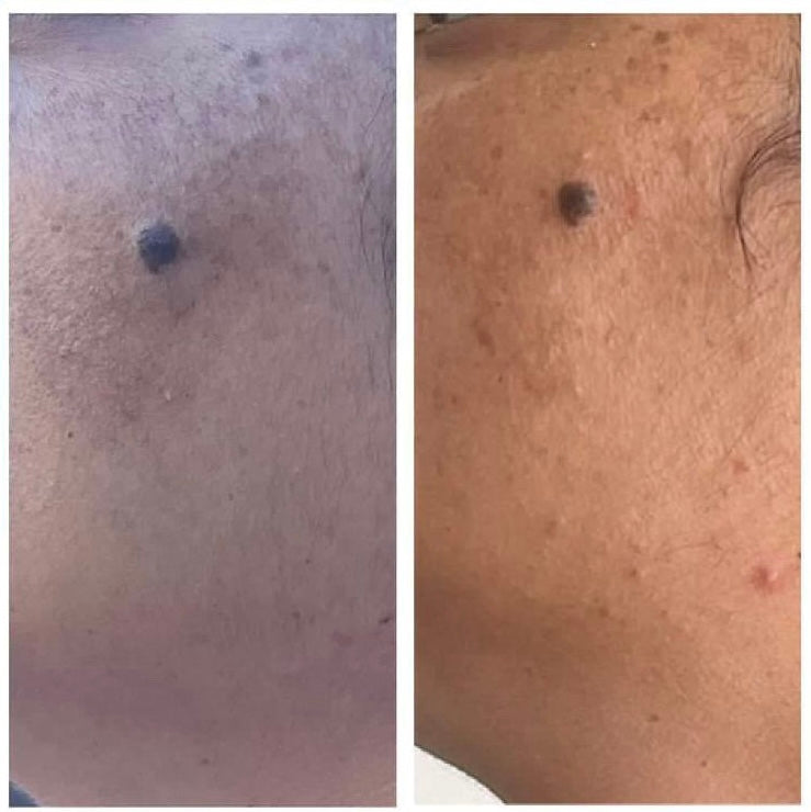 Before and after skin tone and clarity improvement around mole – CWG Client client