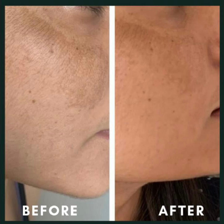 Before and after pigmentation and melasma fading on cheek – CWG result