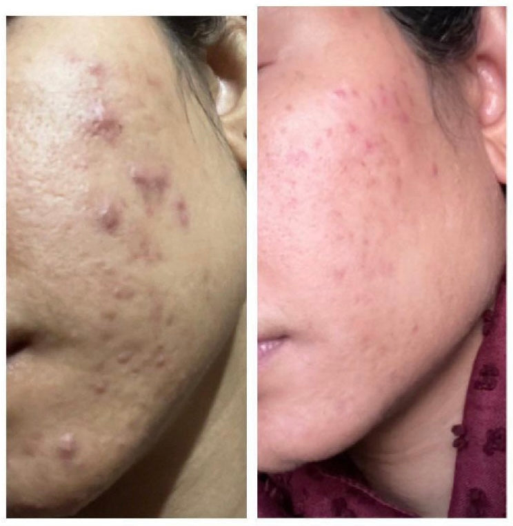 Before and after acne scarring and breakout healing on cheek –CWG client