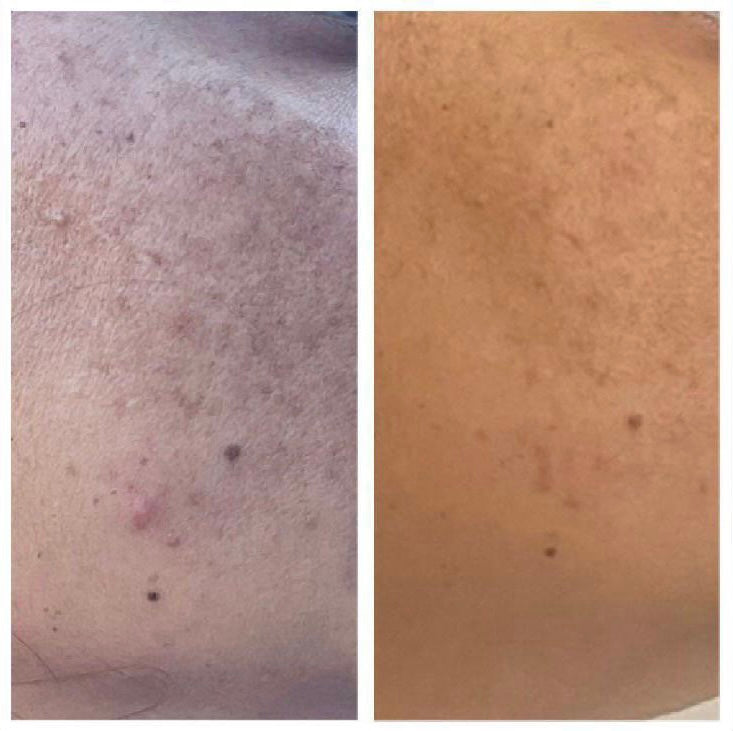 Before and after back and shoulder skin clarity improvement – CWG client