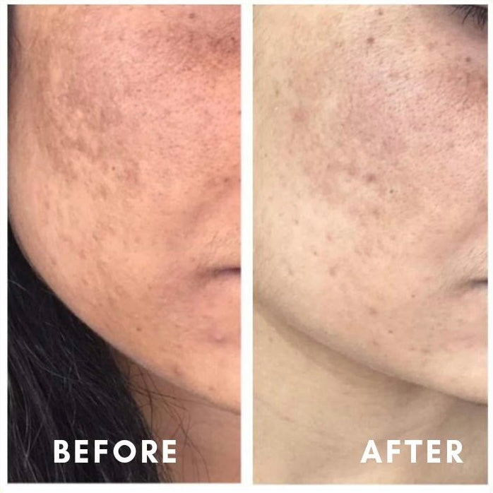 Before and after acne scarring and pigmentation fading on cheek – CWG client