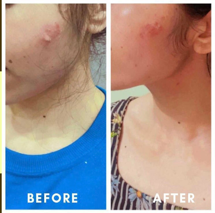 Before and after neck and jaw skin healing – GC CWG client transformation