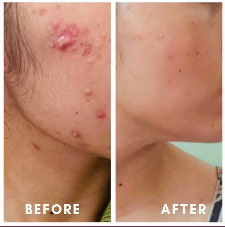 Before and after severe acne healing on cheek – GC  Diet client result